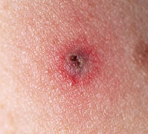 Infected Tick Bite